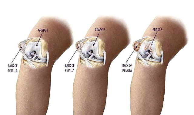 Sorlife：中老年人膝關節疼痛應該怎樣保護與緩解